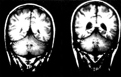 enlargedventricles